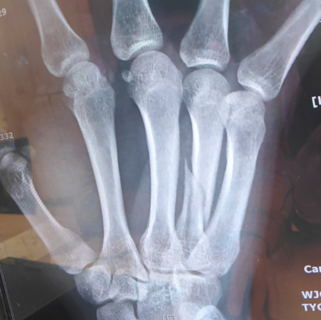 ▲盧學叡打球打到骨裂，為此打上了石膏。（圖／翻攝自盧學叡Instagram）