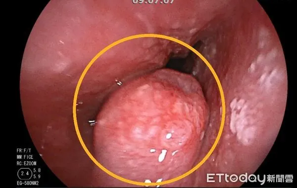 ▲透過內視鏡可看到陳姓患者的食道腫瘤(黃圈處)。（圖／衛福部南投醫院提供，下同）