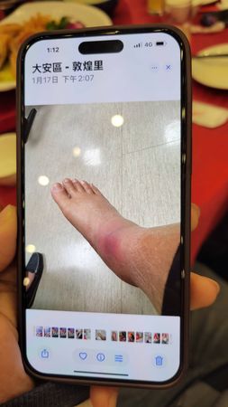 ▲孔鏘腳生怪病突然超級浮腫。（圖／記者葉文正翻攝）