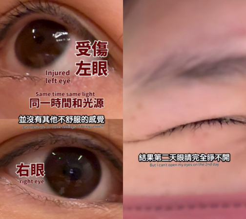 ▲▼Ashly髮夾戳眼「眼角膜破洞」！　延誤1天就醫：差點失明了。（圖／翻攝自Instagram／ashlychan0113）
