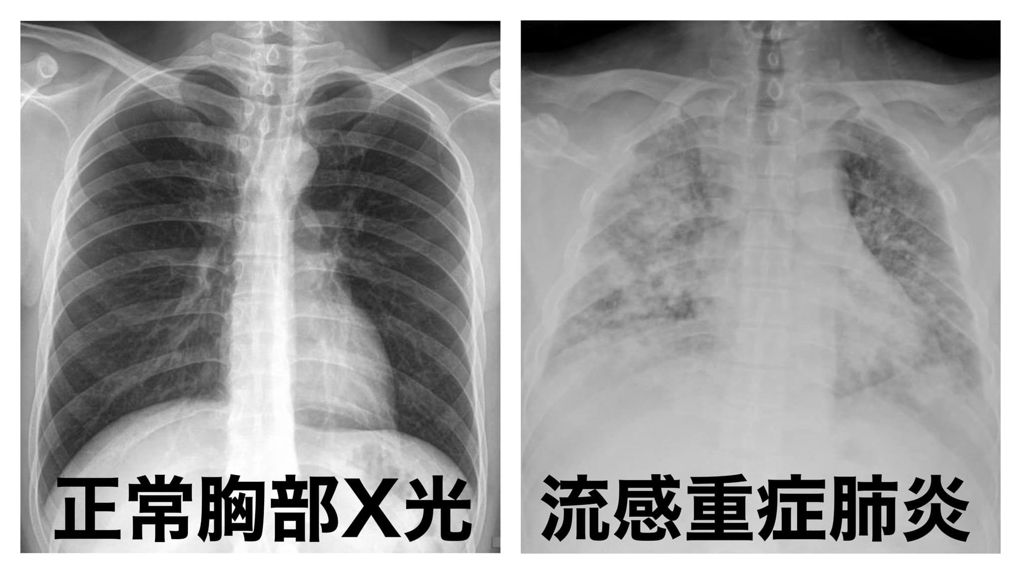 ▲▼大S病逝「怎麼肺炎，人就走了？」　醫揭2大關鍵：流感不是感冒。（圖／翻攝自臉書／杜承哲醫師）