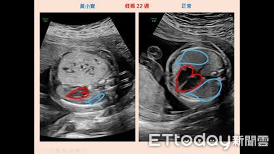 22周胎兒長「罕見肺腫瘤」　北榮團隊成功搶救！