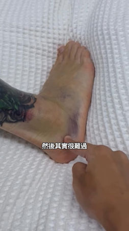 ▲王陽明腳踝嚴重扭傷。（圖／翻攝自王陽明Instagram）