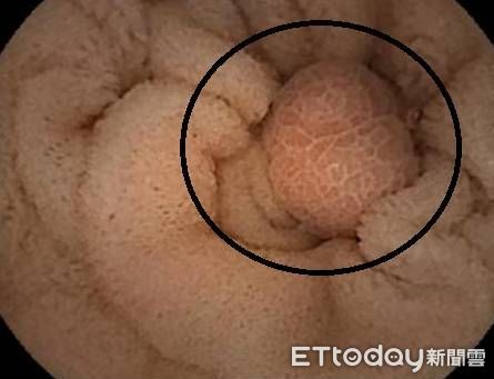 ▲▼  腸胃道持續出血找無出血點 膠囊內視鏡建大功  。（圖／嘉義大林慈濟醫院提供）