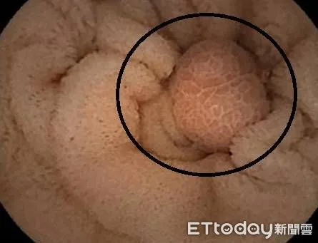 ▲▼  腸胃道持續出血找無出血點 膠囊內視鏡建大功  。（圖／嘉義大林慈濟醫院提供）