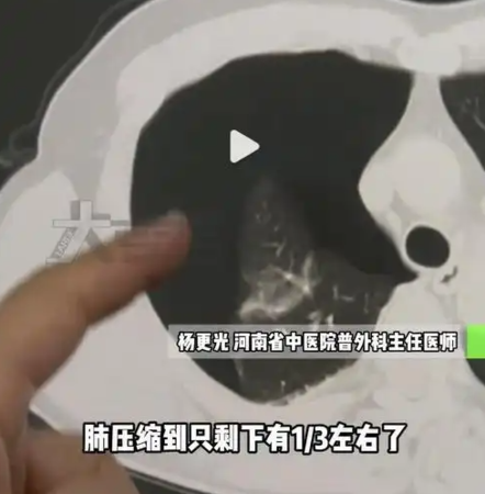 ▲▼35歲男減肥做20個伏地挺身。（圖／翻攝自微博）