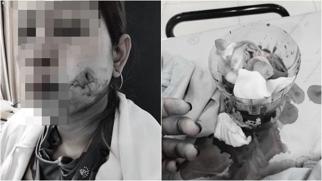 ▲▼酒窩整形失敗！　她右臉頰傷口「血流不止」暈死。（圖／翻攝臉書ต้นอ้อ เป็นหนึ่ง）