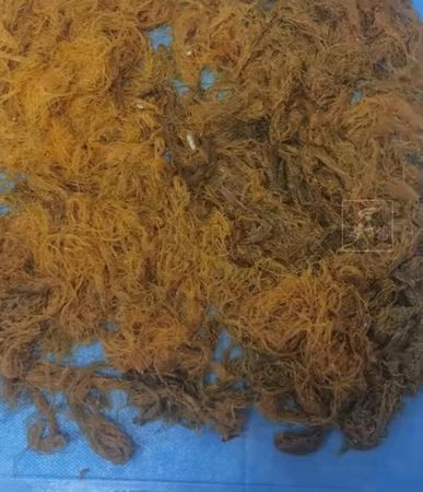 ▲▼取出的異物。（圖／翻攝自寧波晚報）