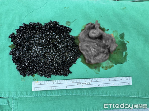 ▲醫師取出的魚子醬狀結石數量驚人，右側為膽囊（經變色處理）。（圖／記者許宥孺翻攝）