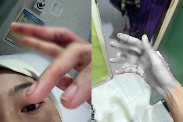 ▲▼貝拉在家中如廁時，突遭巨蟒攻擊、大腿被咬，她徒手與蟒蛇搏鬥後手部受傷。（圖／翻攝自Facebook）