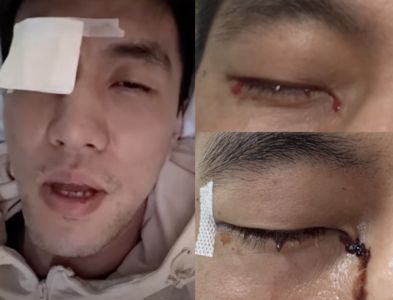 陸球星郭艾倫對抗遭「戳碎結膜」：以後可能打不了籃球了！