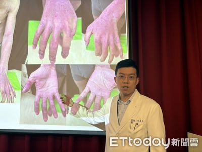 少女異位性皮膚炎「全身流湯」!還因類固醇臉腫 新療法數月改善