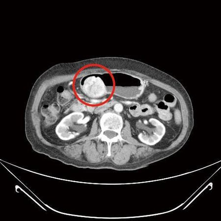 ▲▼婦人同時有胃腸道基質瘤與膽囊炎。（圖／國泰醫院提供）