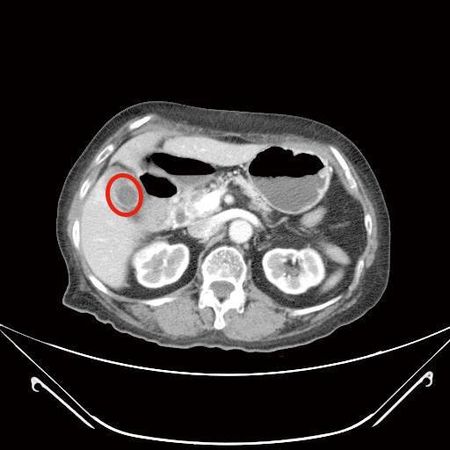 ▲▼婦人同時有胃腸道基質瘤與膽囊炎。（圖／國泰醫院提供）