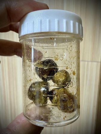 ▲阿BEN膽結石開刀，徐小可昨天有陪伴。（圖／翻攝臉書）