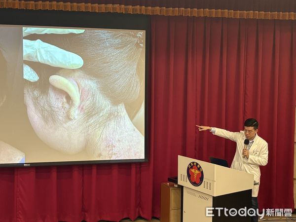 ▲▼三軍總醫院皮膚部醫師陳奕先分享異位性皮膚炎新興療法。（圖／記者洪巧藍攝）