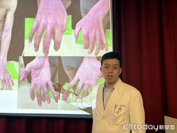▲▼三軍總醫院皮膚部醫師陳奕先分享異位性皮膚炎新興療法。（圖／記者洪巧藍攝）