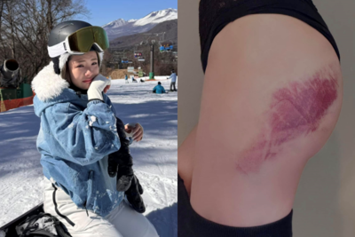 鮪魚跪地爆哭「脫褲曬屁股大片瘀青」！　日本滑雪慘摔惹網心疼