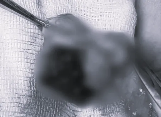 ▲▼10歲童蛋蛋遭同學踢碎。（圖／翻攝自新聞晨報）