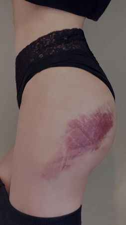 ▲鮪魚脫下褲子，露出大片瘀血。（圖／翻攝自Facebook／徐瑋吟 鮪魚）