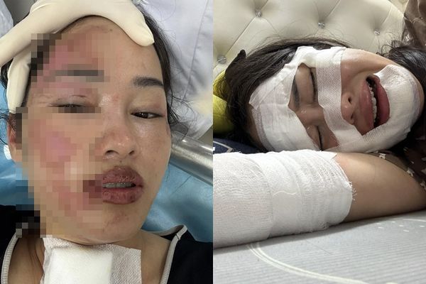 ▲▼慶生氣球「碰到蠟燭」爆炸！　她半邊臉燒到冒煙。（圖／翻攝自Facebook／Giang Phạm）