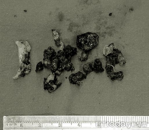 ▲她一直聞到腳臭味！醫拖出「巨型發霉鼻屎」擺滿桌：塞爆了。（圖／陳世璽醫師授權提供）