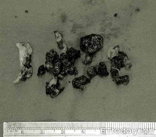 ▲她一直聞到腳臭味！醫拖出「巨型發霉鼻屎」擺滿桌：塞爆了。（圖／陳世璽醫師授權提供）