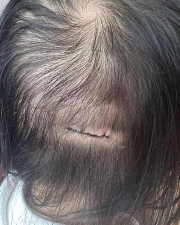 ▲陳柏宇愛女頭破縫7針。（圖／翻攝自符曉薇Instagram）