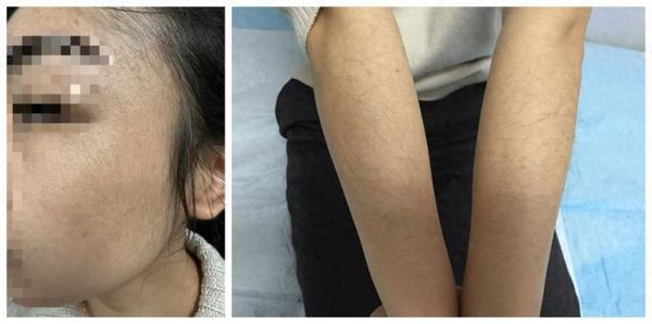 ▲▼一名大陸女子使用生髮液後竟在手部長毛。（圖／翻攝自極目新聞）