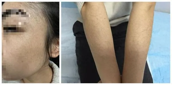 ▲▼一名大陸女子使用生髮液後竟在手部長毛。（圖／翻攝自極目新聞）