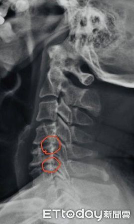 ▲▼工程師頸椎第四五六節椎間盤突出接受手術，住院3天後即返家，回診評估無須復健。（圖／記者許宥孺翻攝）