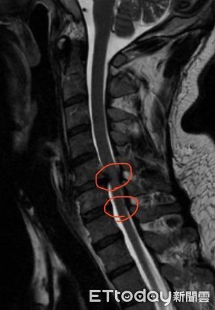 ▲▼美甲霧眉師接受頸椎第5/6/7節頸椎椎間盤置換手術，現已恢復正常生活。（圖／記者許宥孺翻攝）