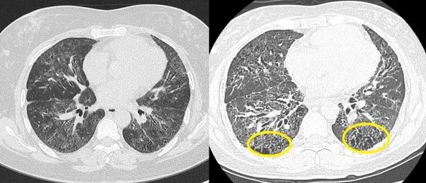 ▲▼蔡秉翰指出病人發病初期下半肺部出現發炎與浸潤(左圖)，後期進展為纖維化形成蜂窩狀之空洞(右圖)。（圖／土城醫院）