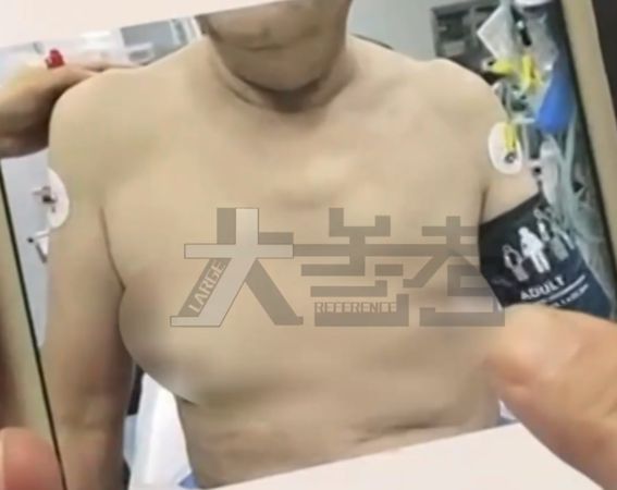 ▲▼每天狂吃一kg瓜子　大叔「罩杯升級」出門得束胸。（圖／翻攝微博）