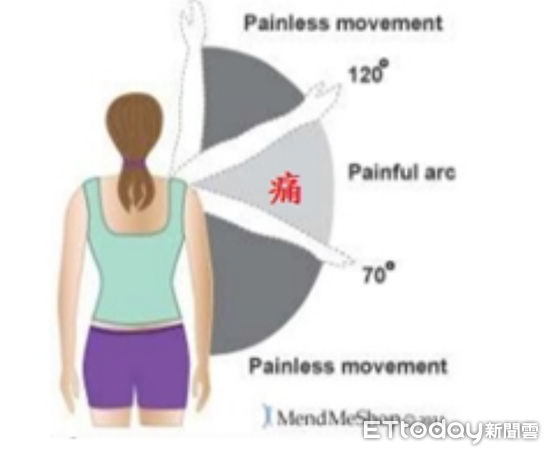 ▲肩關節夾擠症候群是肩部常見疾病之一。（圖／台中榮總埔里分院提供，下同）