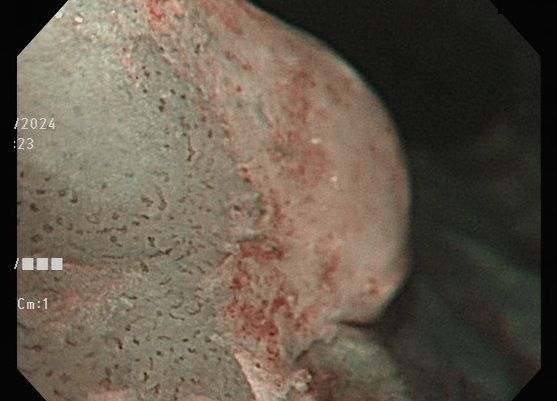 ▲台中男「酒後不舒服」罹癌第3期！醫揭1症狀：腫瘤已塞食道60%。（圖／烏日林新醫院提供）
