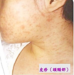 20歲男確診!桃園出現首例本土麻疹 衛生局籲落實防疫