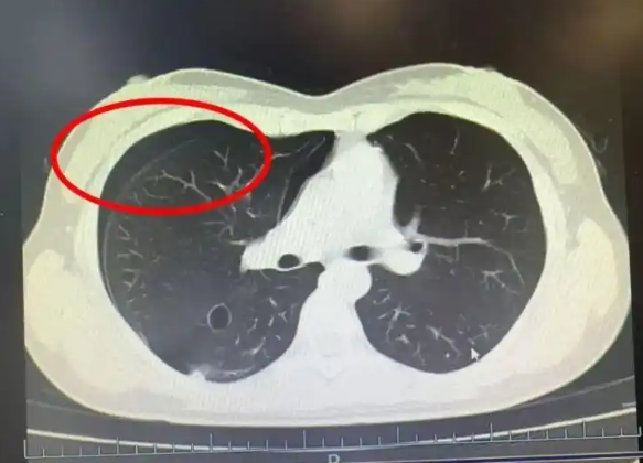 ▲▼女子跳繩1個月瘦10kg卻爆肺。（圖／翻攝自紅星新聞）