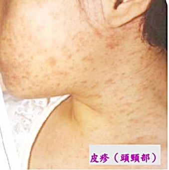 ▲桃市出現首例本土麻疹個案，圖為麻疹確診者外觀。（圖／衛生局提供）