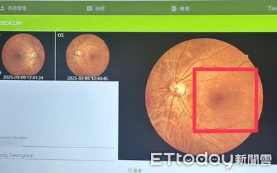 35歲女罹糖尿病 眼底檢查驚見視網膜輕微病變