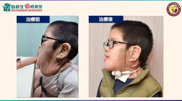 ▲▼男童罹叢狀神經纖維瘤持續增長至2顆棒球大，口服標靶治療助擺脫呼吸器重拾正常生活。（圖／台灣小兒神經醫學會提供）