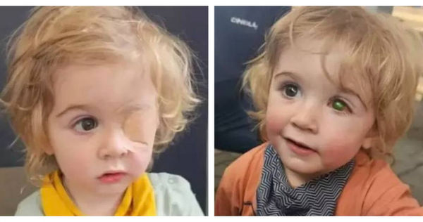 英國兩歲幼童因親友的一個親吻，不幸感染單純疱疹病毒（HSV），左眼失明。（圖／翻攝自X）