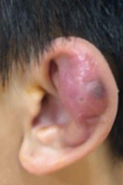 ▲▼耳洞感染綠膿桿菌，變成蜂窩性組織炎。（圖／台北慈濟醫院提供）