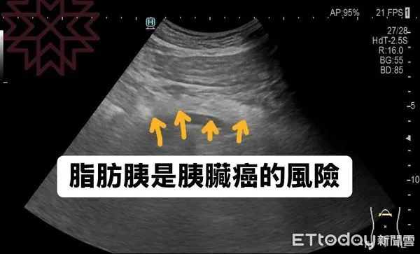 ▲▼62%罹癌王患者「都有1特徵」！　醫點名6種人最危險。（圖／林相宏醫師授權提供）
