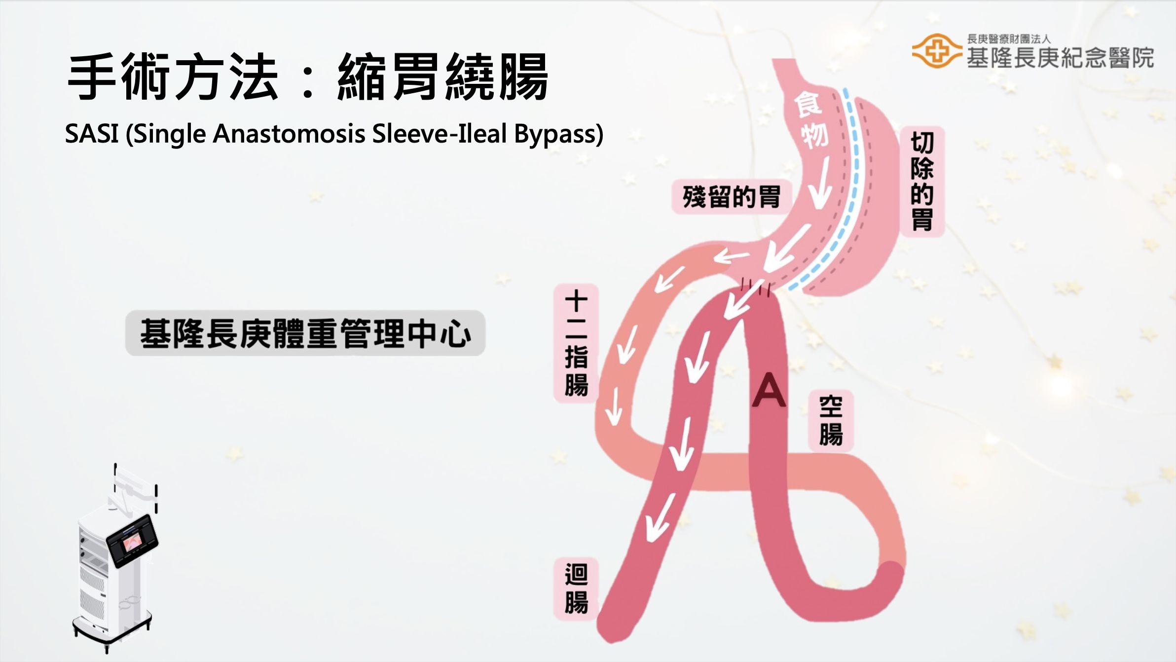 ▲▼長庚醫院病態性肥胖患者手術減重，縮胃繞腸術式。（圖／長庚醫院提供）