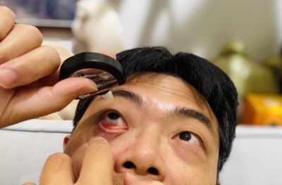 吃炸物、常熬夜讓針眼上身 藥師揭5招加速消退:溫熱濕敷有效