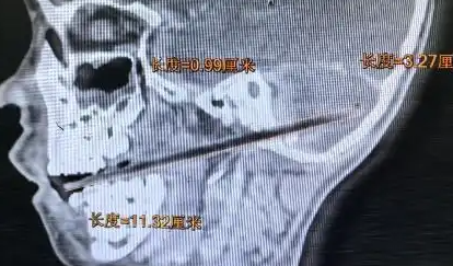 ▲竹籤刺進小朱顱內。（圖／翻攝自廣州日報）
