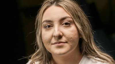 看起來臉變大！　醫示警「壓力害的」：膠原蛋白被吃掉