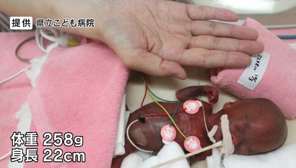關野龍佑出生時僅258克，比成人手掌還小。（翻攝X@FNN_News）