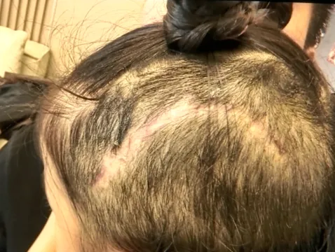 ▲▼遊樂設施吃髮，5歲女頭皮撕裂13cm。（圖／翻攝自瀟湘晨報）